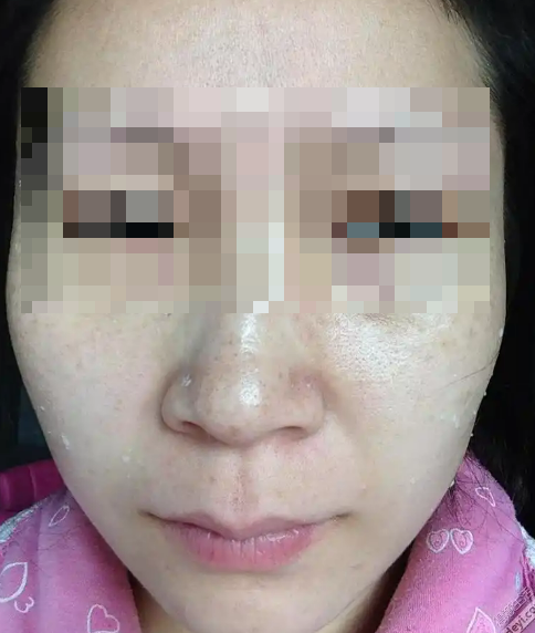 갱년기 이후 발생하는 기미&amp;#44; 검버섯&amp;#44; 도미나 크림으로 발라보니 2달 소요