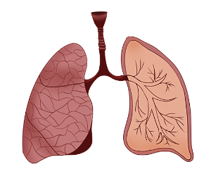 폐렴증상-이미지