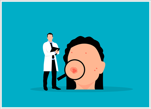 검버섯 갑자기 생기면