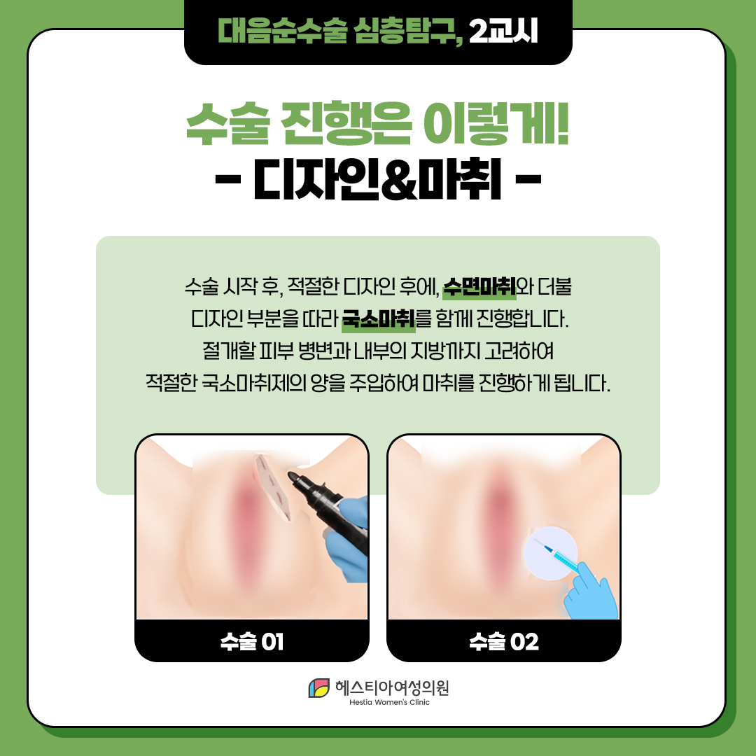 대음순수술 진행 디자인&마취