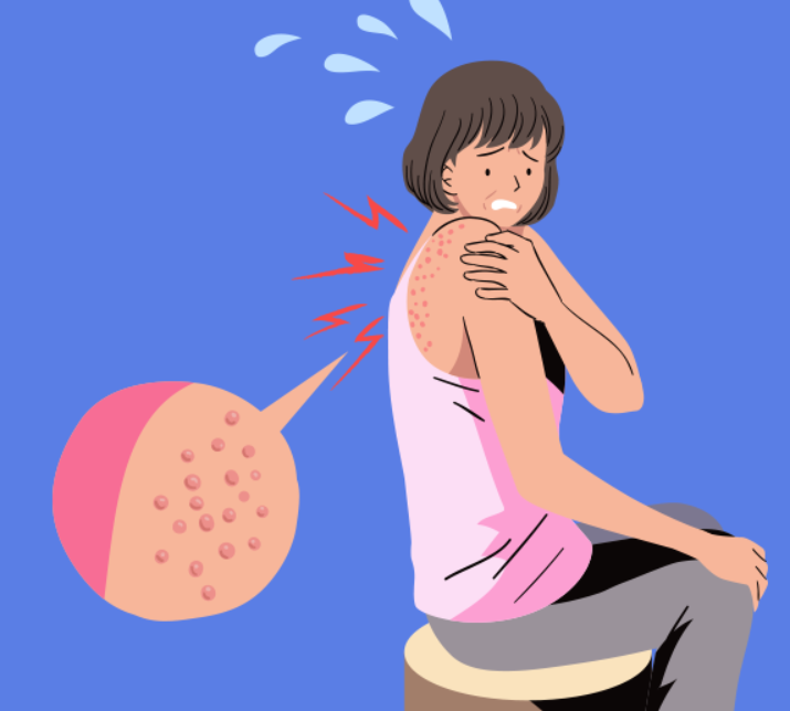 대상포진초기 치료