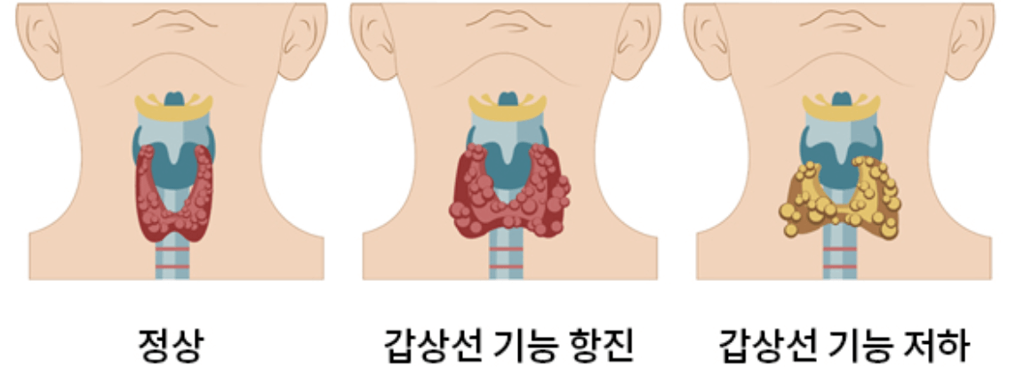 갑상선-기능-항진증-증상