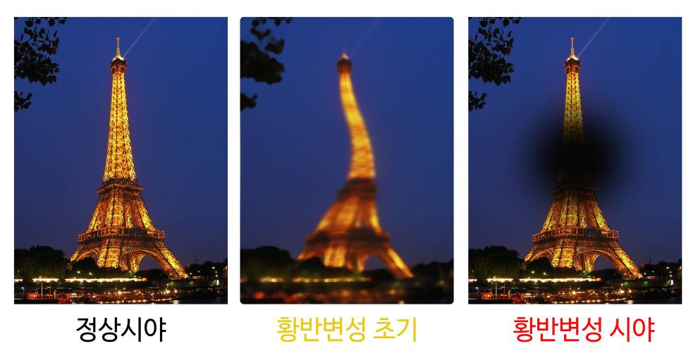 황반변성 증상