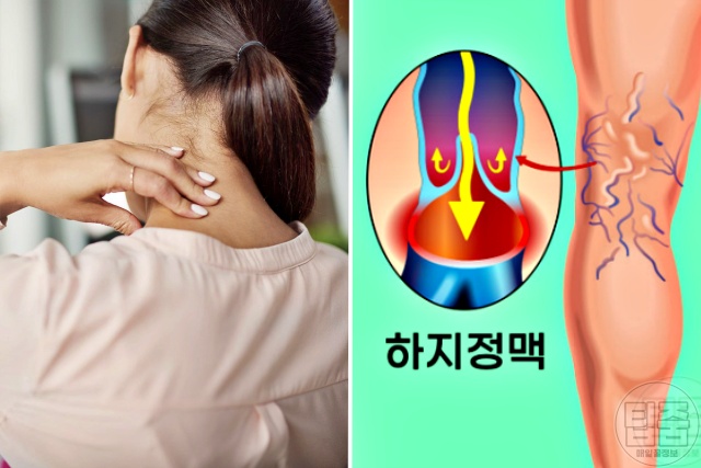 고지혈증 증상 초기증상 혈압 고지혈증원인