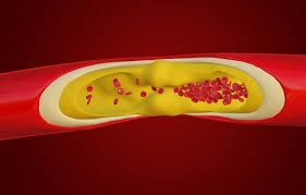 중성지방 정상수치
