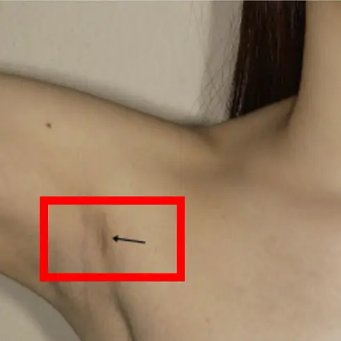 갑상선암 절개 수술 흉터와 로봇수술 흉터 비교-2