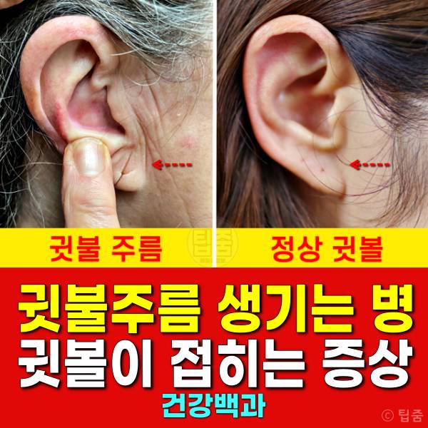 귓불주름 귓볼주름 귓볼이 접히는 증상