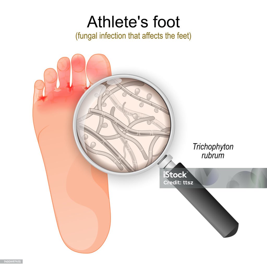 무좀을 발생시키는 감염원인