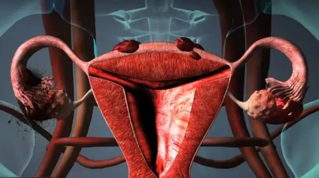 자궁내막증이란?