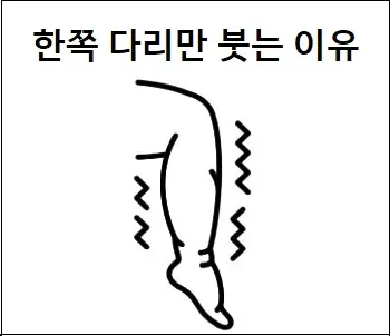 한쪽 다리만 붓는 이유