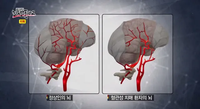 혈관성치매 원인 증상 치료법과 예방 생활습관_7