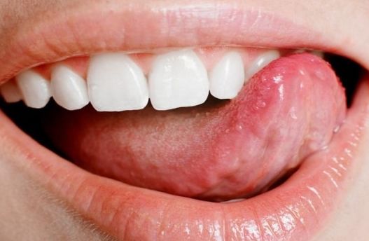 혀가 꼬이는 증상