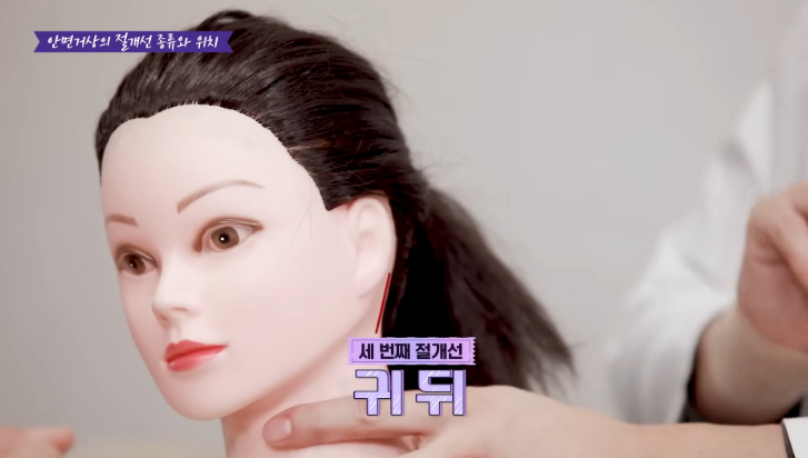 신사역성형외과 안면거상흉터 귀뒤 절개