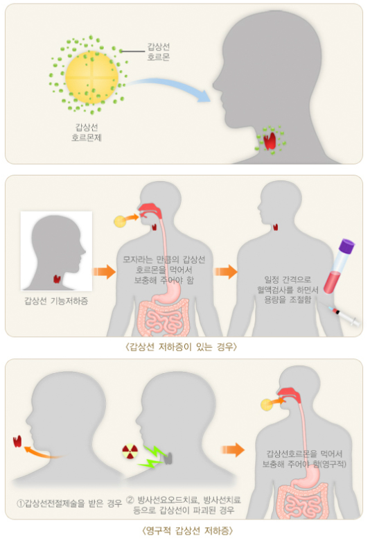 감상선 기능 저하증 치료