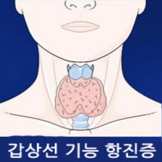 갑상선 기능 항진증