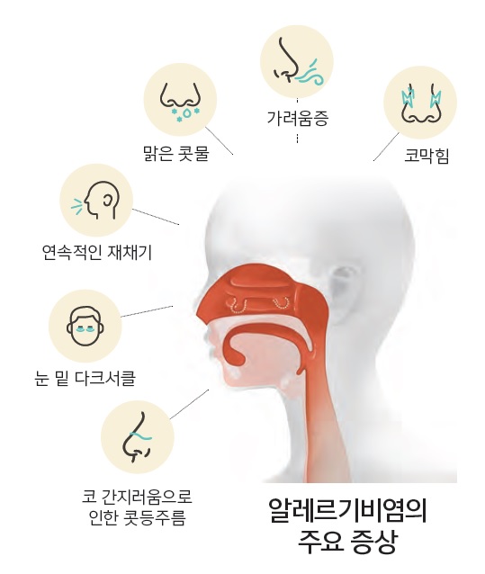 알레르기 비염 증상을 나타낸 그림