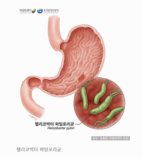 위암 초기 증상, 놓치지 말아야 할 경고 신호