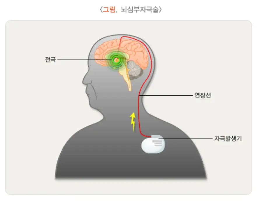 뇌심부작극술-수술치료-이미지
