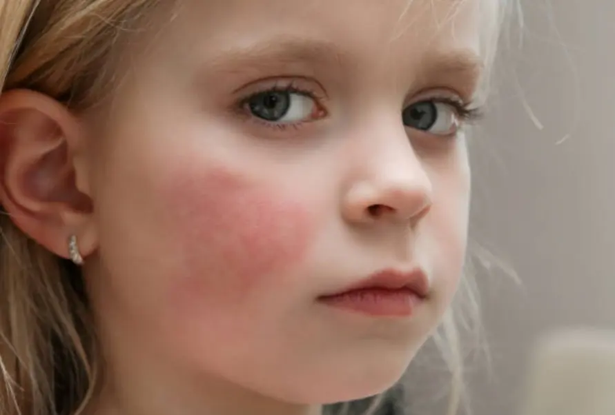 빰 맞은 병 전염성 홍반