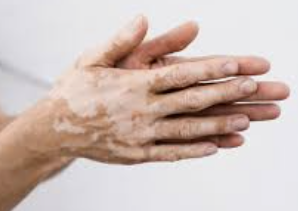 백반증 초기증상 4