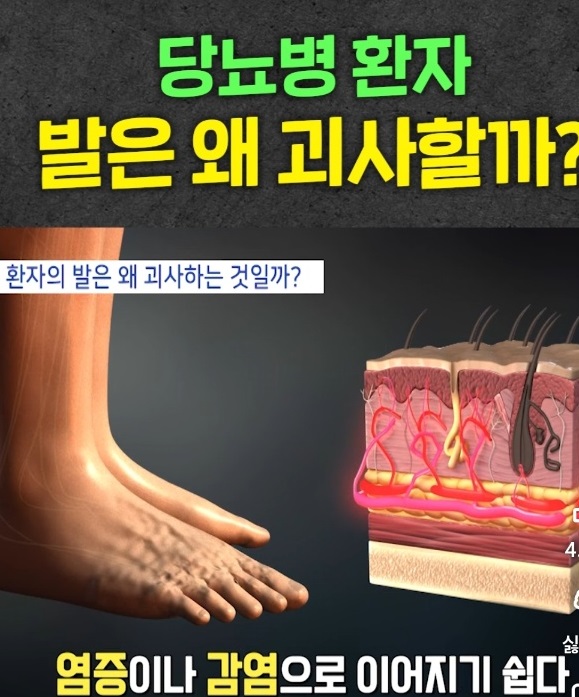 명의-당뇨발-천동일-교수-족부-정형외과