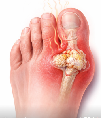 통풍 완전 가이드(검사법,자가테스트,좋은 음식,식단표)