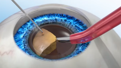 백내장 수술 발전과 인공수정체의 중요성 관련 이미지