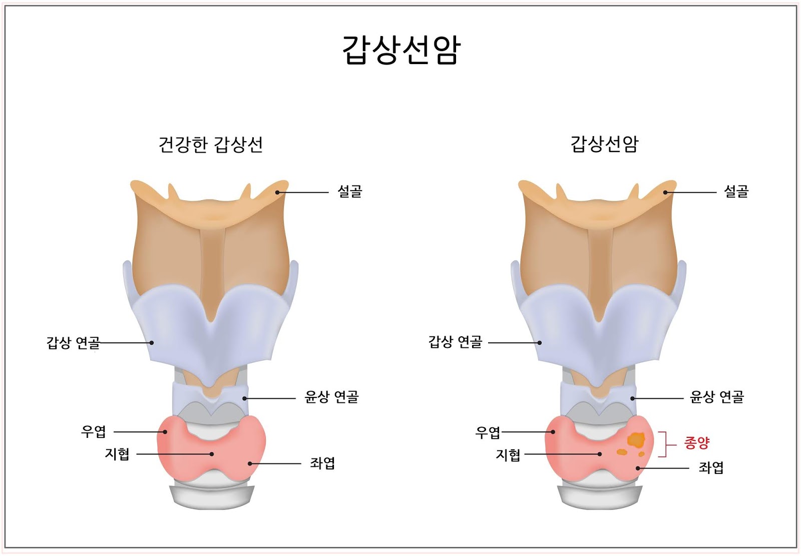 갑상선암