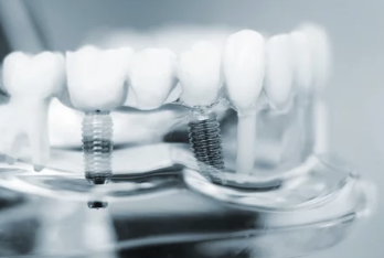 임플란트 모형 사진