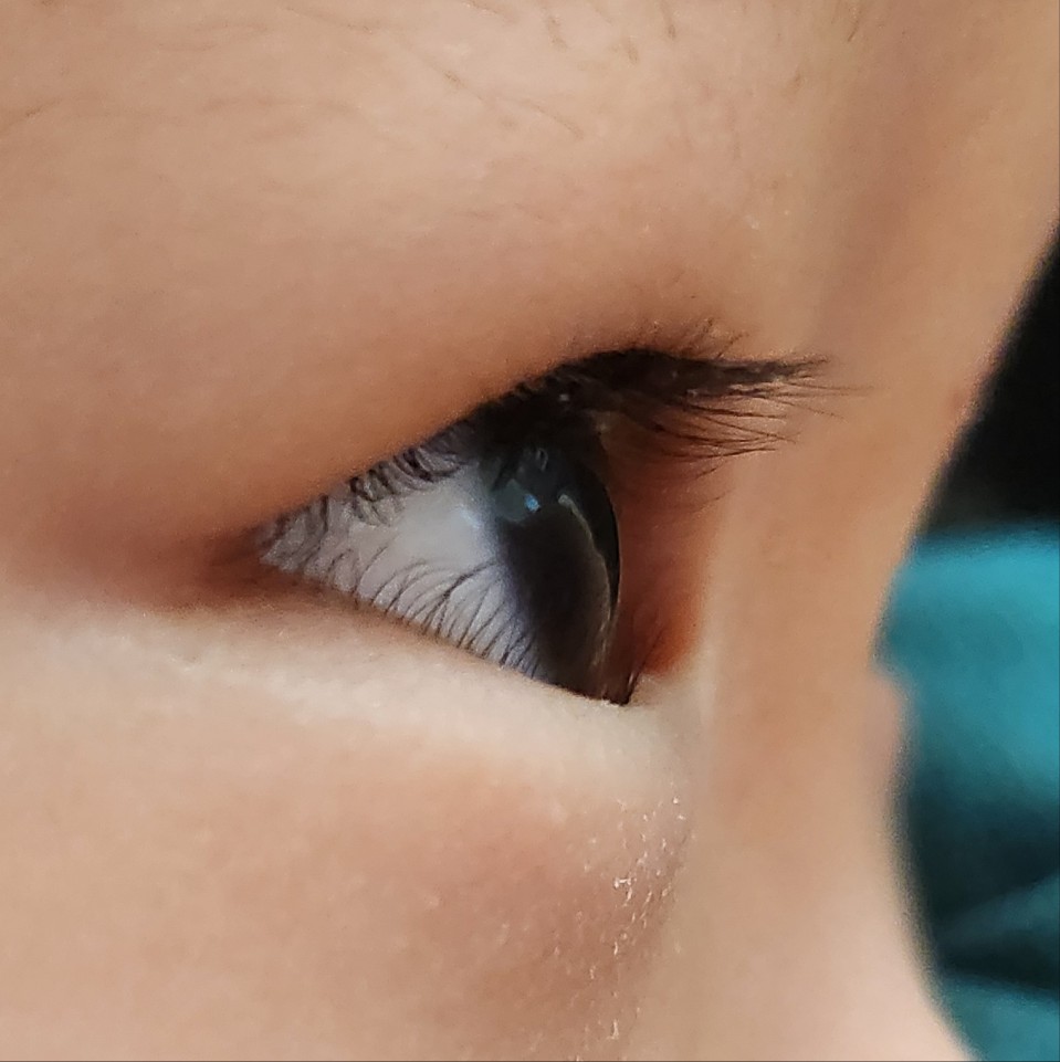 아래 속눈썹이 눈을 찌르는 모습
