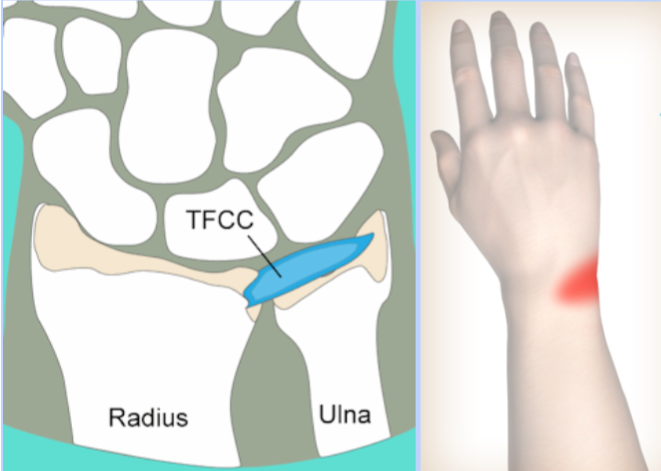 삼각섬유연골-척골충돌증후군-TFCC