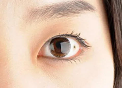 시야에 검은점 시야에 까만점이 보일때 원인과 대처법_6