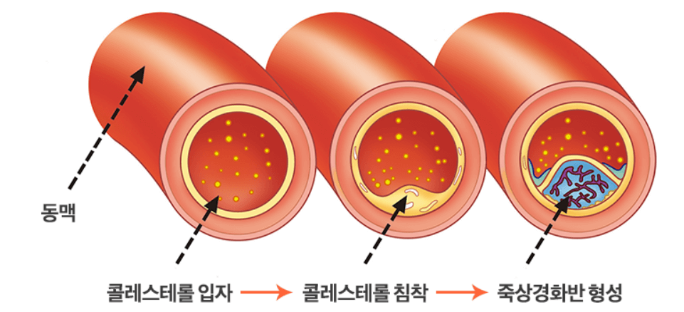고지혈증