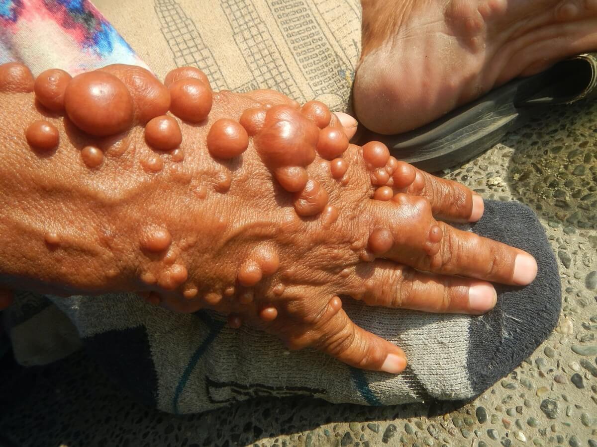 손에-난-신경섬유종
