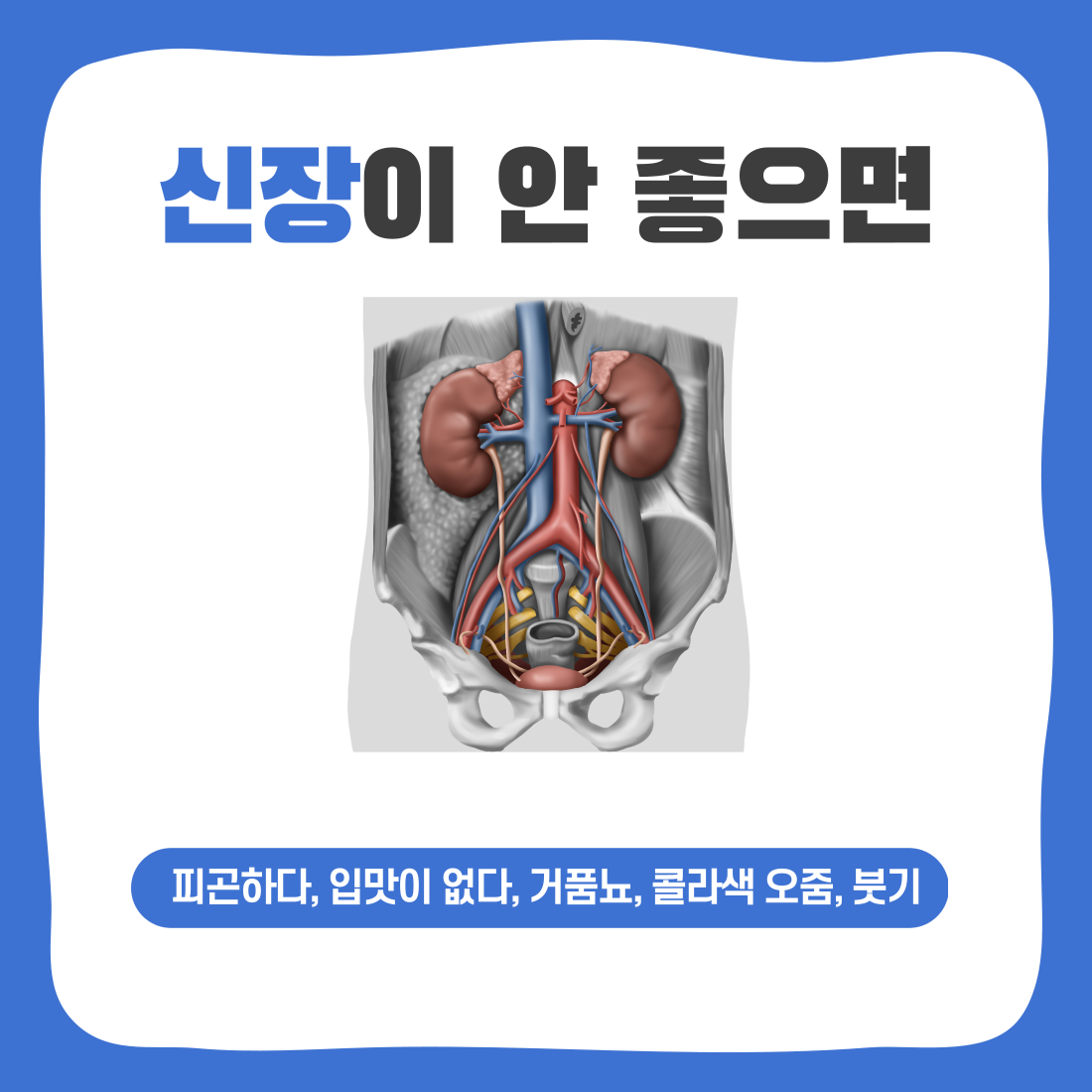 신장이 안좋으면 피곤하거나 입맛이 없고 콜라색 오줌이나 거품이 있는 오줌을 누게 됩니다. 또한 몸이 이유없이 붓게 됩니다.