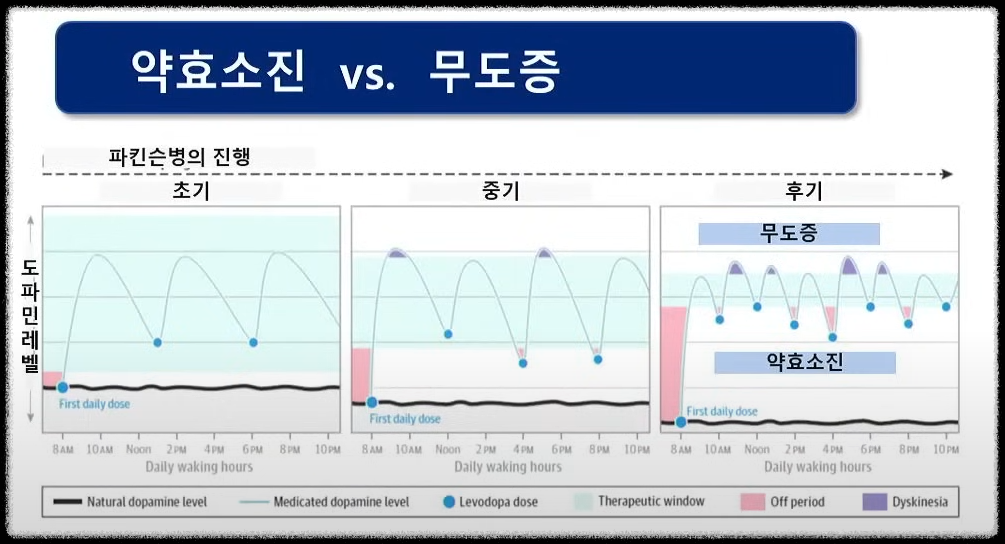 피킨슨병의 치료는 개인 맞춤형 치료