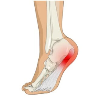 족저근막염부위
