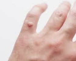 사마귀 제거방법 1