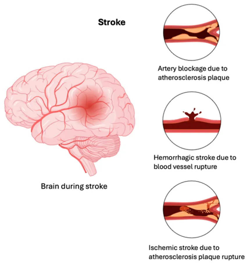뇌졸중 초기 증상 이것만 알자