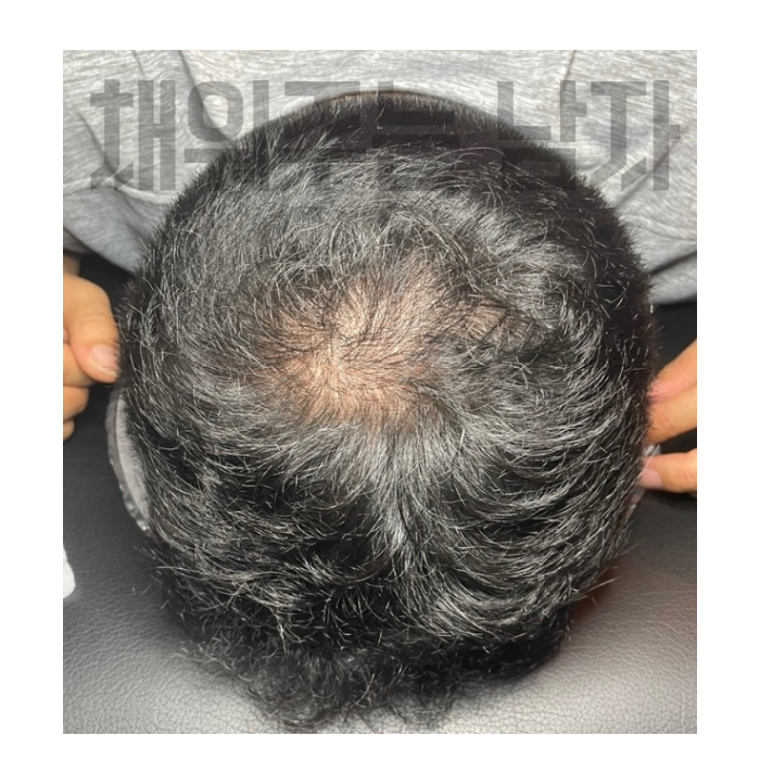 두피문신 SMP 정수리탈모 커버