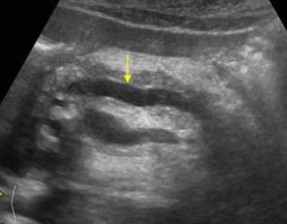 Ampulla Vater Cancer