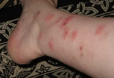 빈대 예방 및 퇴치