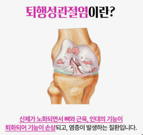 퇴행성관절염이란? 이미지