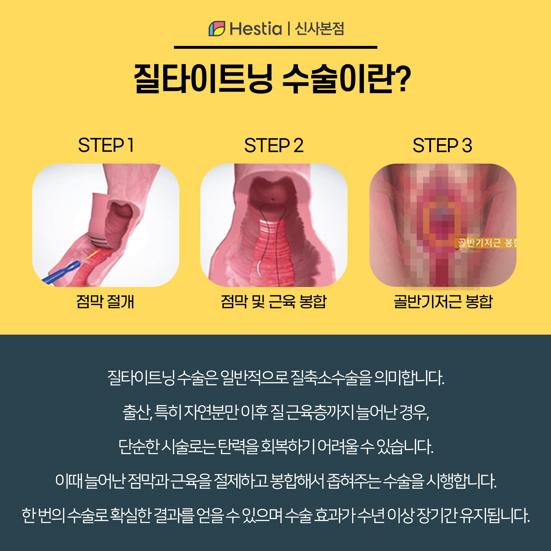 질타이트닝 수술이란?