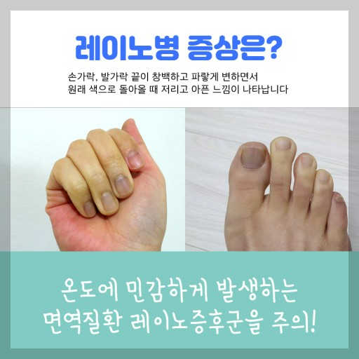 호흡기 질환: 청색증- 종류, 원인, 증상, 진단방법, 치료방법.