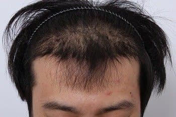 모발이식 후기