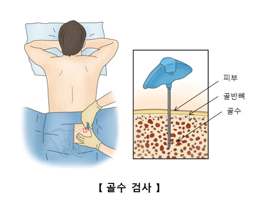 급성골수백혈병 증상부터 치료까지