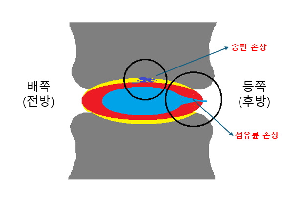가장 흔한 디스크 손상