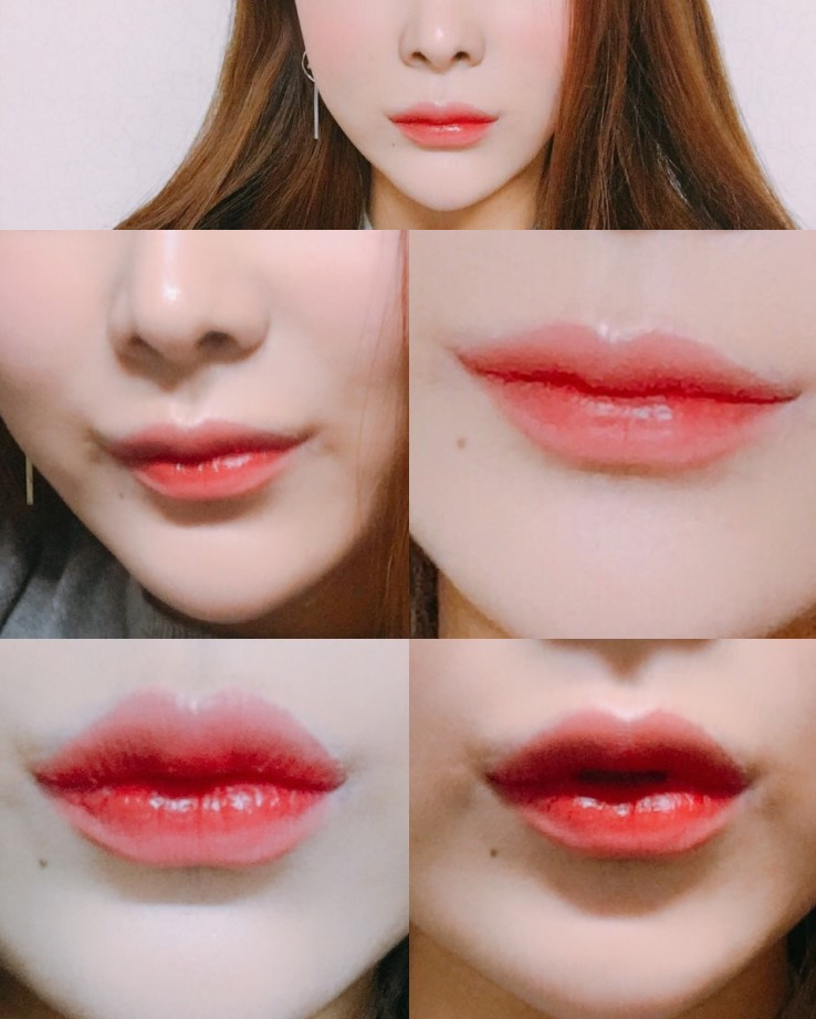 입술확대수술