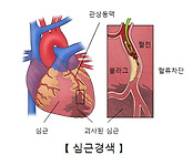 심근경색 전조증상